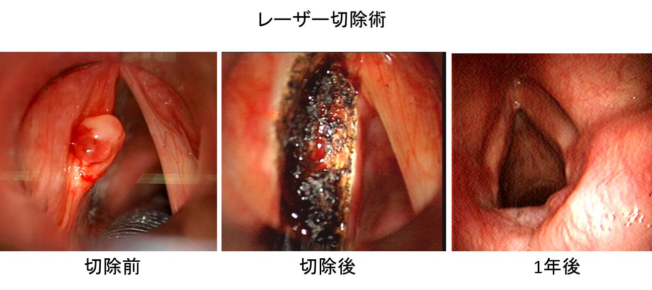 ん 初期 症状 喉頭 が 喉頭がん｜頭頸部がん｜がん研有明病院